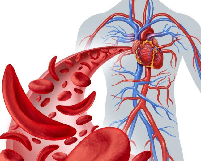 Sickle Cell Disease