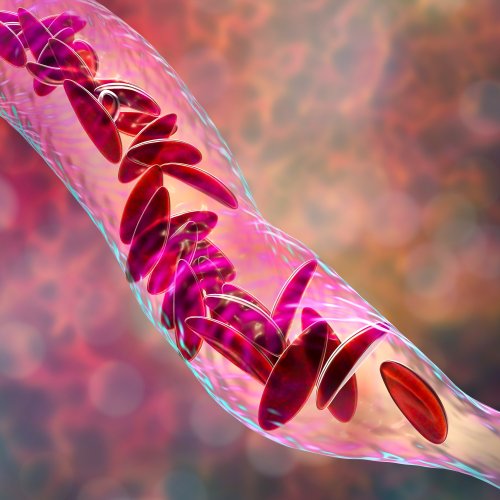 sickle cell graphic